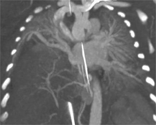 CT arteriography: coronal slice demonstrating anatomy of pulmonary veins with two left sided pulmonary veins draining into the left atrium and the single right sided upper pulmonary vein also draining into the left atrium.