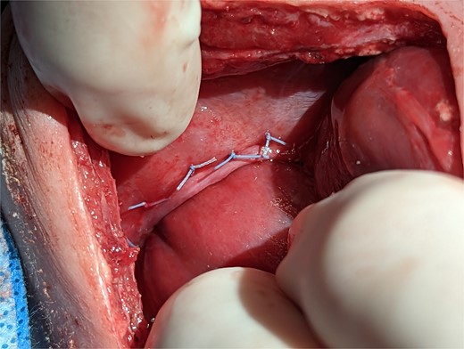 Intraoperative technique: the liver is plicated to the diaphragm with interrupted horizontal mattress sutures creating a seal between the thoracic and intra-abdominal cavities.