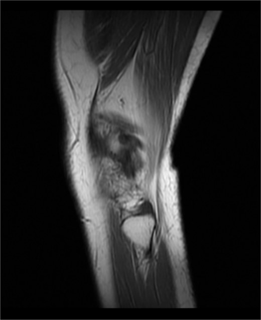 Pre-operation MRI image of the right knee joint of this patient.