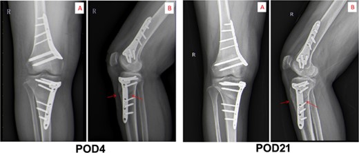 Computed axial tomography of chest. The images of CT scan on POD4 and POD21.