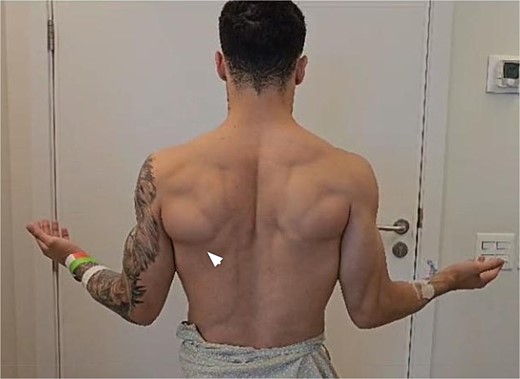 Clinical image of the patient’s back showing a muscle deformity on the left side, at the teres major/latissimus dorsi topography, indicated by the white arrow.