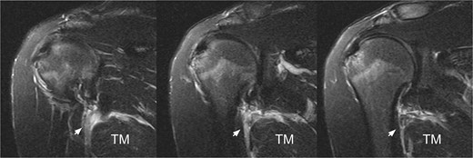 T2-weighted MRI revealing a hyperintense signal at the myotendinous junction of the teres major, indicated by the white arrow.