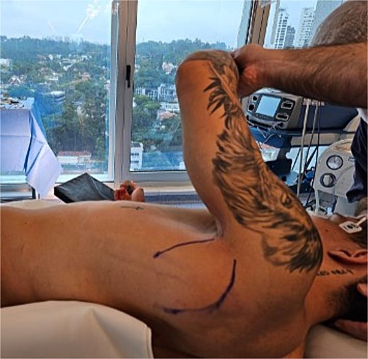 Patient positioned in a right lateral decubitus position with the left upper limb free over the body in 90° abduction.