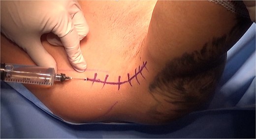 A single incision was made at the level of the posterior axillary fold, ~8 cm in length.