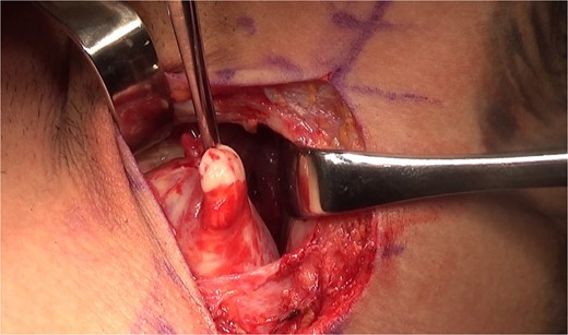 Complete tear of the teres major at the myotendinous junction.