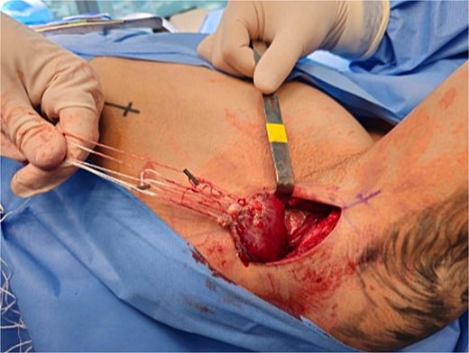 Teres major tendon tied with FiberWire.