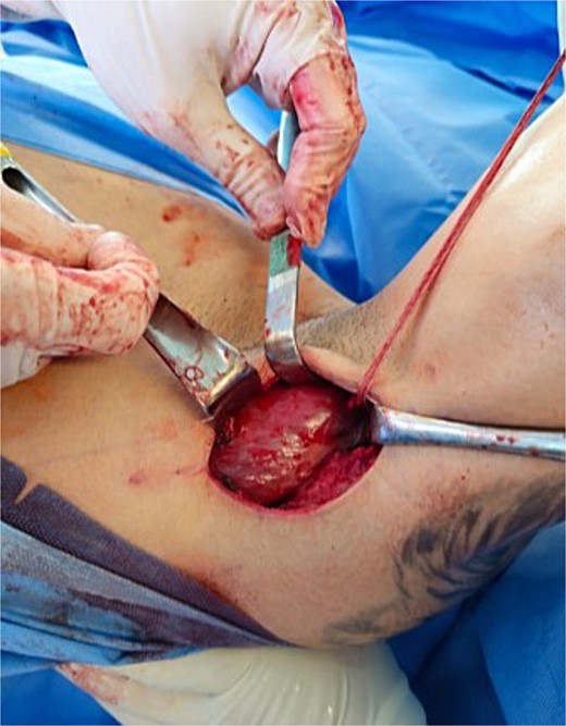 Teres major after the repair.