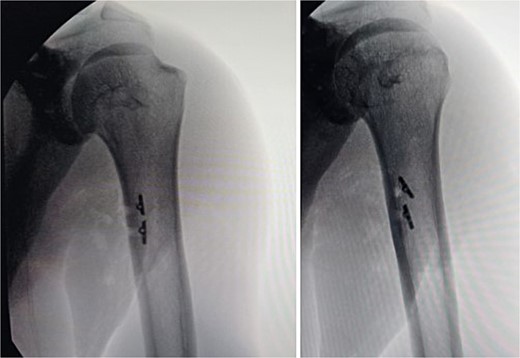 Post-surgery anteroposterior radiographies of the arm showing both Pec Buttons used for the teres major repair.