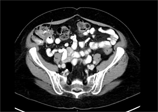 Computed tomography abdomen/pelvis—arrow indicates ascending colon mass.