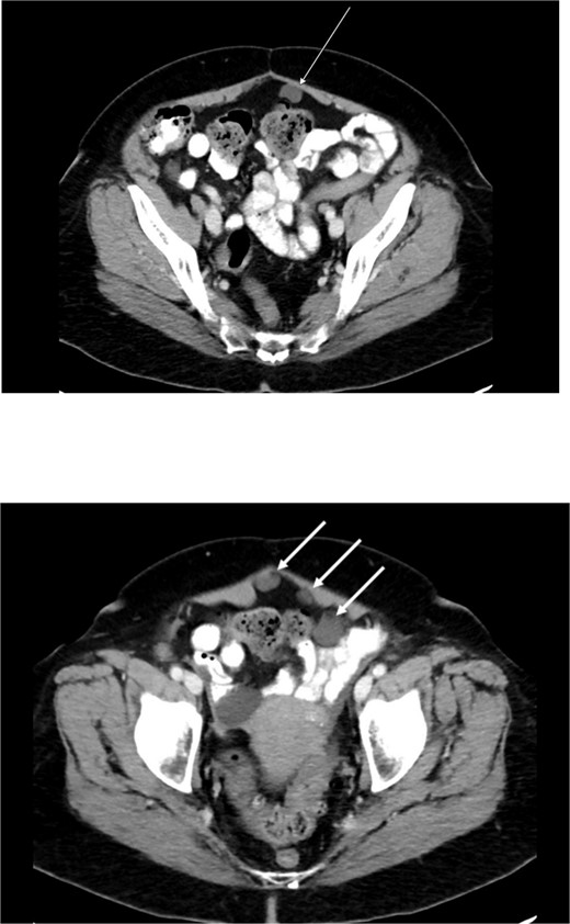 Computed tomography abdomen/pelvis—arrows indicate peritoneal cysts.