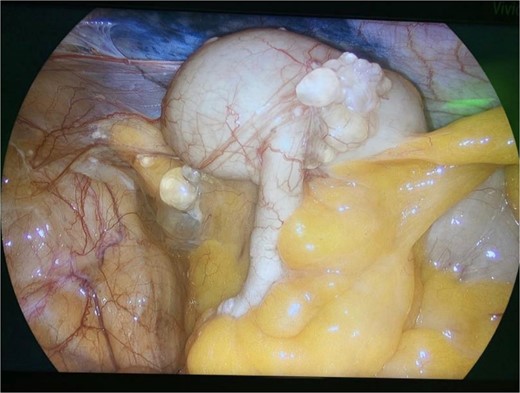 Intraoperative view of the right lower quadrant of the abdomen: cysts involving peritoneum of the right colon and mesentery.