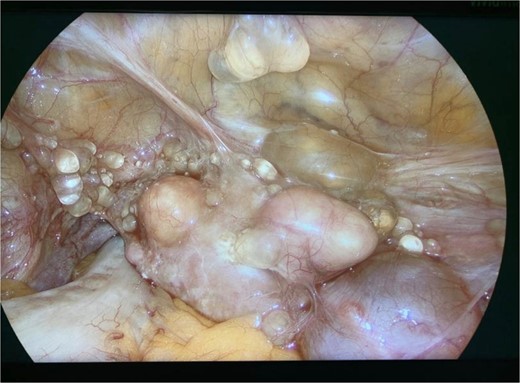 Intraoperative view of the pelvis: multiple cysts involving the peritoneum.
