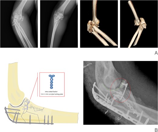 (A) X-ray and CT three-dimensional reconstruction examination of elbow fracture. (B) Diagram of intra-osteal fixation of comminuted coronoid process fracture with mini plate and postoperative X-ray examination of the elbow.