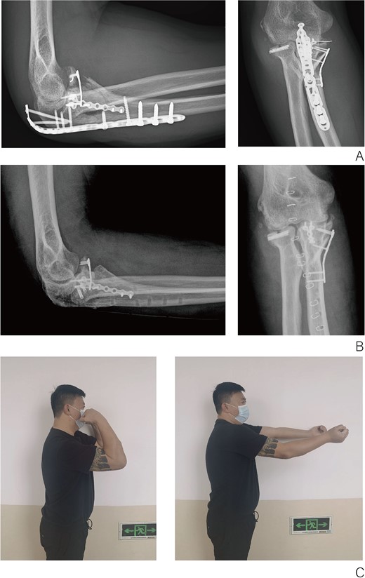 (A) X-ray of elbow at 3 months after surgery. (B) X-ray of elbow at 1 year after surgery. (C) Function of elbow at 6 months after surgery.