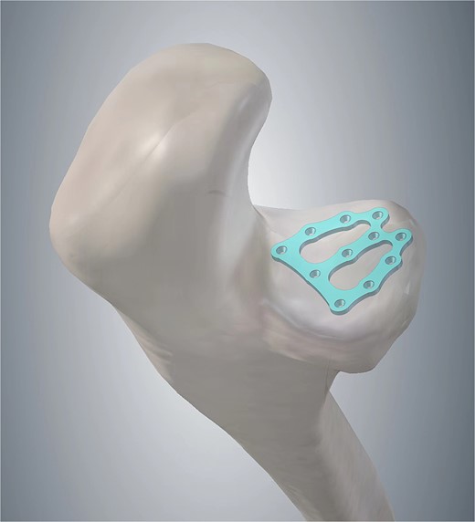 Patent drawing of the mini-plate for intra-osteal fixation of comminuted coronoid process fracture.