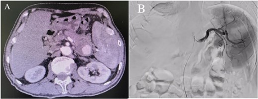 (A) Abdominal CT scan showed the presence of a SAP. (B) Celiac angiography confirmed that the main trunk of the splenic artery showed contrast agent overflow and the formation of a pseudoaneurysm of the splenic artery.