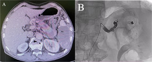 (A) Abdominal CT scan 6 days after the embolization showed no filling of the pseudoaneurysm. (B) After embolization, re-examination showed that the main trunk of the splenic artery was accurately occluded, and the staining of the pseudoaneurysm of the splenic artery disappeared.