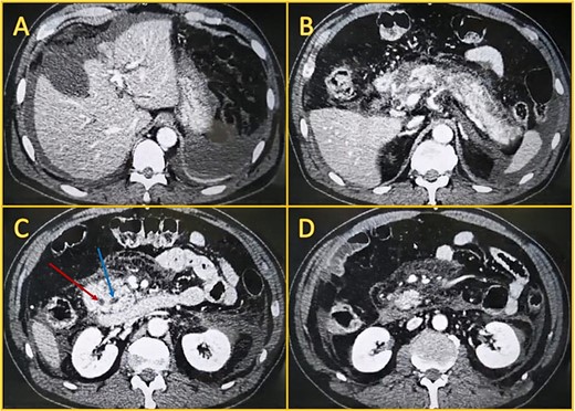 Contrast-enhanced computed tomography. A: Perihepatic fluid. B: The pancreatic head, body, and tail have non-enhancing areas compatible with necrosis. C: Dilated biliary duct (leftmost arrow) and Wirsung (rightmost arrow). D: Peripancreatic fluid.