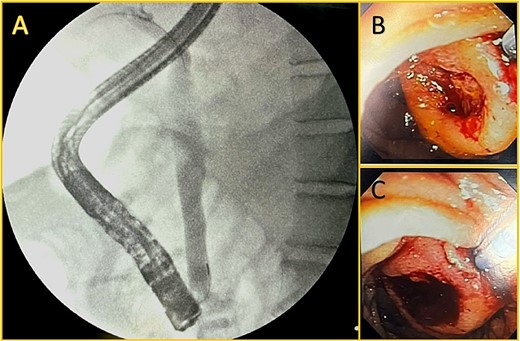 Endoscopic retrograde cholangiopancreatography. A: Cholangiography is shown, and successful cannulation of the biliary duct was achieved, with the identification of a dilated duct and no filling defect. B and C: An ampullary mass is shown with surface ulceration.