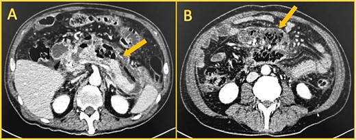 Shows contrast-enhanced computed CT. A: Large collection (arrow) anterior to the pancreas, with gas. B: Walled-off necrosis (arrow) with gas.