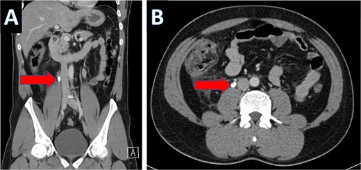 CT scan showing right ureteral calculus (A: coronal; B: axial).