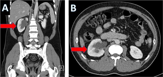 CT scan showing hydronephrosis of the right kidney (A: coronal; B: axial).