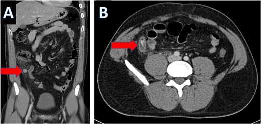 Coronal CT scan showing appendicolith (A) and axial CT showing appendicitis (B).