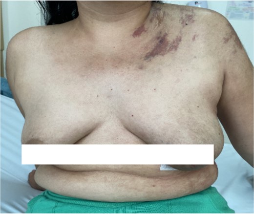 Cutaneous vascular lesions.