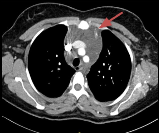 Mediastinal mass.