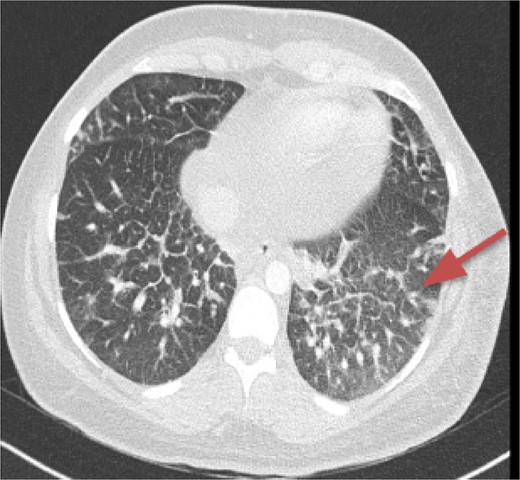 Thickening of interlobular septa in both lungs.
