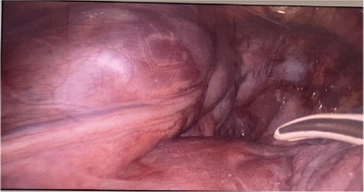 Mediastinal mass with cystic characteristics.