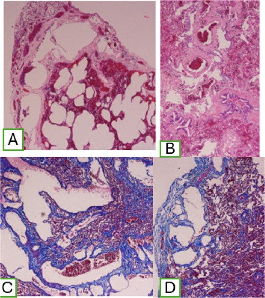 (A) Dilatation of subpleural lymphatic vessels; (B) peribronchovascular compromise; and (C) positive Masson staining.
