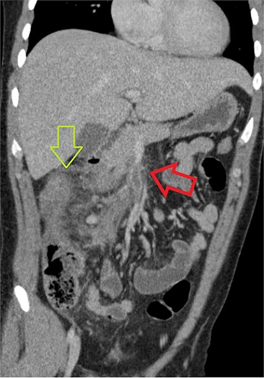CT of abdomen and pelvis showing a thrombus within the superior mesenteric vein, identified with a red (or horizontal) arrow. Some linear foci which may be branching of hypoattenuation in segment 8 of the liver which possibly related to distal branches of the right portal vein and could represent early portal vein thrombosis. The green (or vertical) arrow identifies colonic edema at the hepatic flexure.
