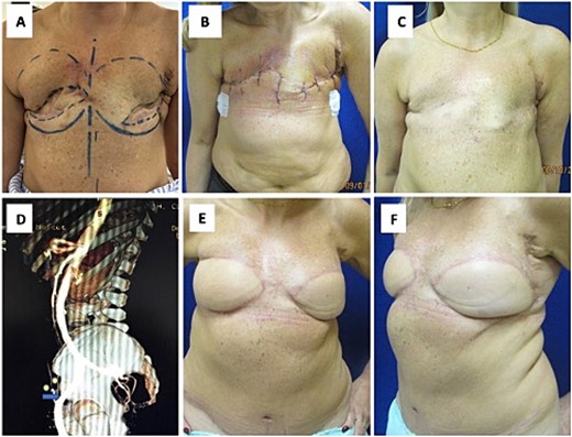 (A, B) Surgical debridement of the scars, (C) lipofilling in the chest wall (123 cc left, 125 cc right), (D) angiotomography confirming the ligation of the deep and superficial inferior epigastric vessels, and (E, F) surgical aspect three months after reconstruction with the TRAM flap.