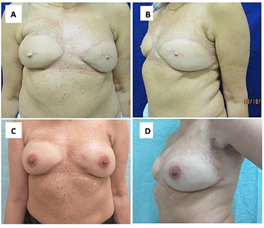 (A, B) Surgical aspect three months after lipofilling and nipple reconstruction. (C, D) Results after 3D tattooing of the nipple–areola complex.