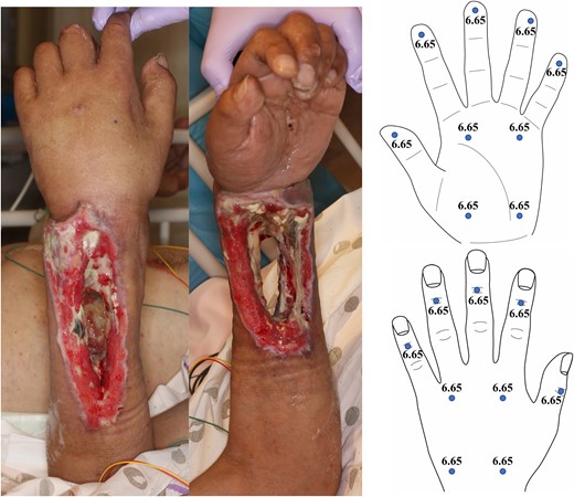 Pre-reconstructive surgery findings (including photographs and Semmes-Weinstein monofilament test) for Case 1.