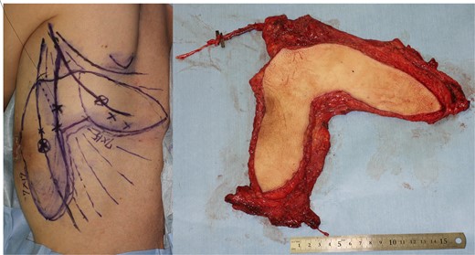 Flap design and appearance following elevation in Case 1.
