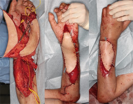 Intraoperative findings of the reconstructed area in Case 1 (The line indicates the split and interposed thoracodorsal nerve for median nerve defect).