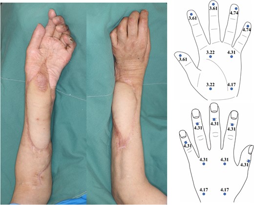 Photographs of the reconstructed area and results of Semmes-Weinstein monofilament test at 11 months postoperatively of Case 1.