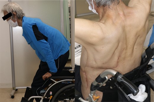 Photographs of the patient standing up from a wheelchair and the donor site of Case 1.