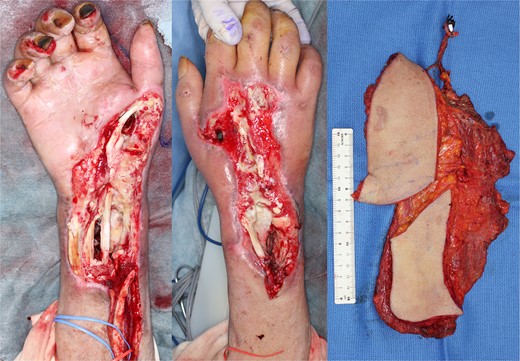 Intraoperative findings of Case 2 (after debridement and elevated flap).