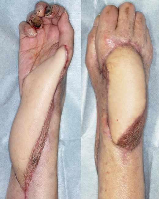 Photographs of the reconstructed area at 4 months postoperatively of Case 2.