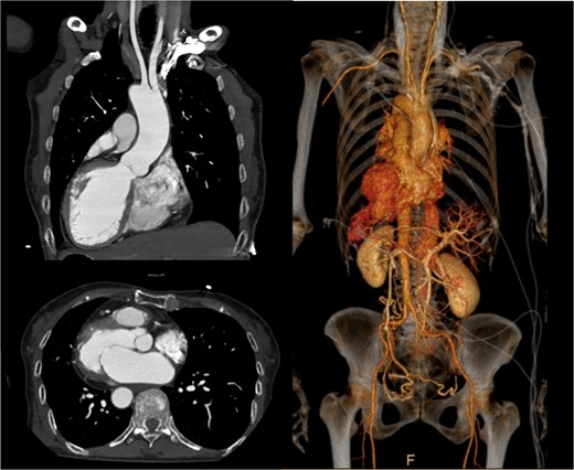 Preoperative contrast-enhanced CT: axial, coronal oblique MIP, and coronal oblique 3D VR images demonstrating situs inversus totalis and dextrocardia.
