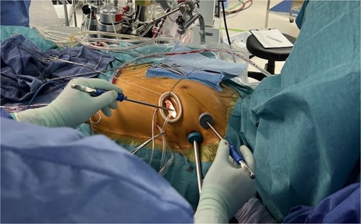 Appearance of the intraoperative surgical field: Setup of the simplified three-port system with 3D endoscopy.