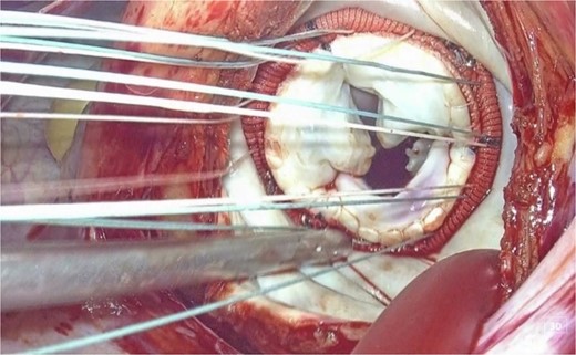 3D endoscopic view of the intraoperative field: Sutures, prosthetic valves, and the Cor-Knot surgical tying device are inserted through the main incision on the left side toward the mitral valve.