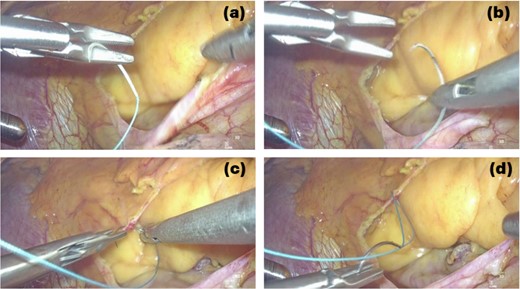 3D endoscopic view of the intraoperative field: We are right-handed, needle thread inserted by using the left-handed forceps is switched to the right-handed needle holder to perform the suture (a → b → c → d).