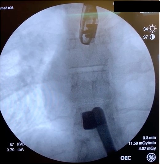 Intraoperative fluoroscopy demonstrating bullet in the right ventricle.