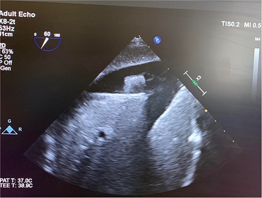 Intraoperative TEE demonstrating the intravascular bullet in the IVC.