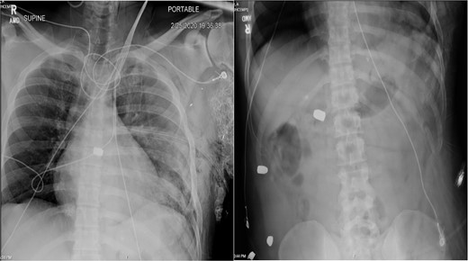 Plain film X-ray obtained in the trauma bay demonstrating multiple bullets overlying the cardiac silhouette and right abdomen.