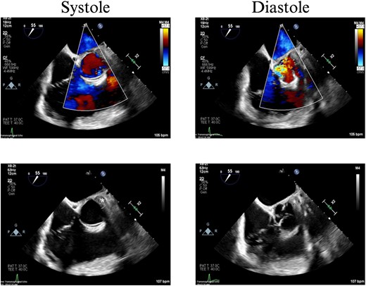TEE with intracardiac bullet, severe aortic insufficiency. The bullet is labeled by an asterisk, with shadow artifact posterior to the bullet.